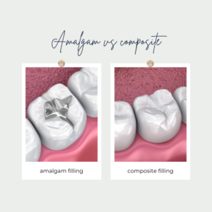 A visual comparison between an amalgam filling and a composite filling