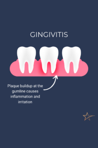 Cartoon graphic of gums and 3 teeth with redness around root of middle tooth representing inflammation caused by gingivitis