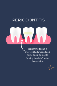 Cartoon graphic of gums and 3 teeth with redness and gapping in the gums surrounding the middle tooth representing the receding of gums with periodontitis