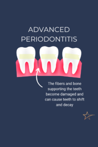 Cartoon graphic of gums and 3 teeth with redness and separation at the gums between the teeth representing inflammation and yellowing on the teeth representing plaque buildup associated with advanced periodontitis