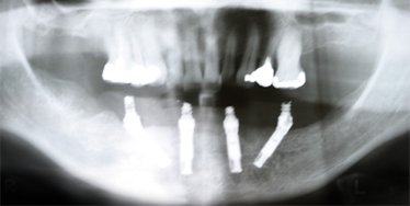 Dental x-ray showing the placement of four dental implants in an edentulous mandible as they would appear in Teeth in a Day.