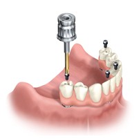 Illustration depicting how a permanent mandibular dental prosthesis is attached to four implants in Teeth in a Day.