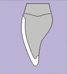 a drawing showing an upper tooth with a thin porcelain veneer placed over the front