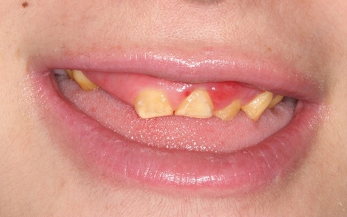 An actual patient of Dr. Tostado before her smile makeover. Her teeth are short, broken, and yellow.