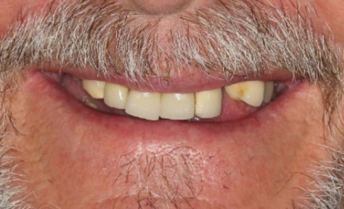 Closeup of mans mouth before bridge work