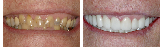 Before-and-after ceramic crowns photos from San Antonio holistic dentist Gilberto Tostado