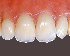 Zirconia crowns on upper front teeth - an option for holistic dentistry
