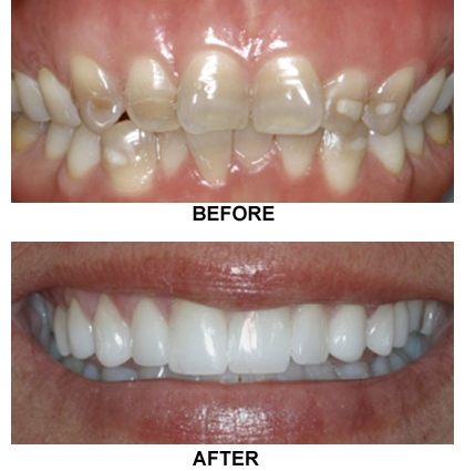 Before-and-after porcelain veneers photos