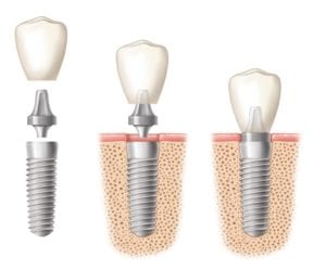 3 dental implant images