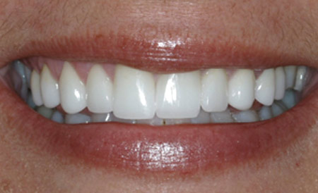 After photo of natural-looking dental crowns from a San Antonio holistic dentist