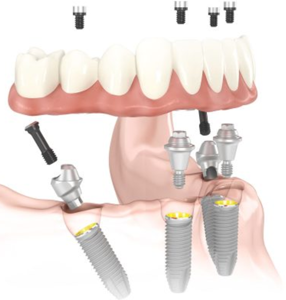 Diagram of All-On-4 implant overdentures