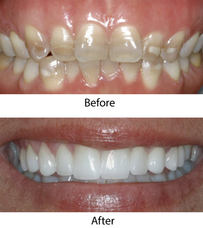 Before and after porcelain veneers photos from San Antonio dentist Gilberto Tostado