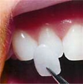 Porcelain veneer being placed on a tooth