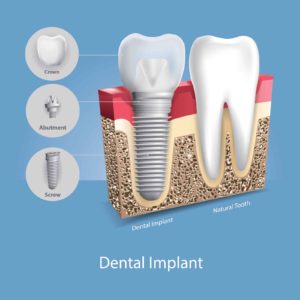 An illustration of a dental implant by a natural tooth