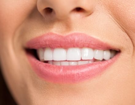 A white smile portraying results of porcelain veneers on tetracylcline stains