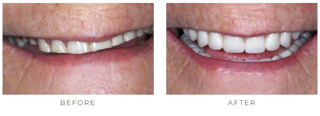 Before-and-after implant overdenture photos from Dr. Gilberto Tostado of San Antonio