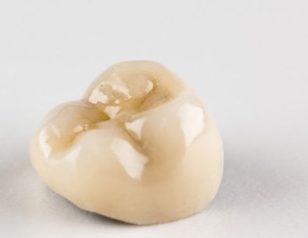 Ceramic crown as an example of what holistic dentists use