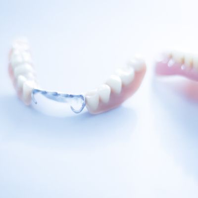 A lower partial denture, as an alternative to a dental implant