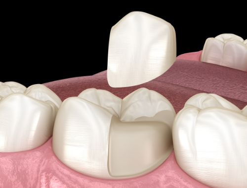 Model of a dental onlay