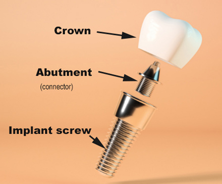A single dental implant with labels for the screw, abutment, and crown