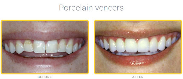 Porcelain veneers before-and-after photos for info on no-prep veneers and whether veneers hurt