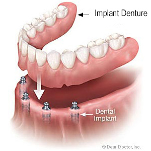Diagram of a lower denture above implants