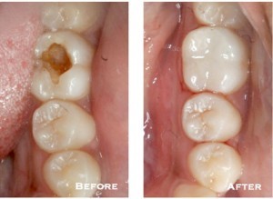 Before and after pictures of composite fillings, available from Dr. Tostado of San Antonio