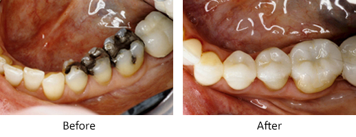 Before and after photos of porcelain onlays, available in San Antonio from Dr. Gilberto Tostado