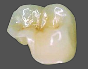 A porcelain onlay for a molar tooth