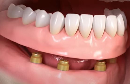 Digal model of four Straumann® dental implants and locators with a lower denture above them