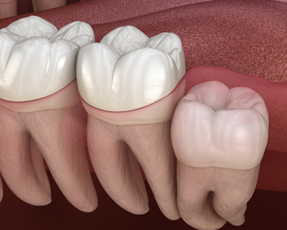 Digital model of a vertically impacted wisdom tooth, which San Antonio dentist Dr. Acuña can remove.