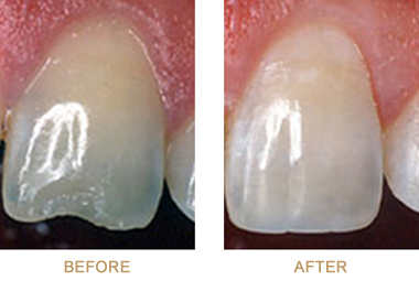 Before and after dental bonding pictures, available from San Antonio prosthodontist Dr. Gilberto Tostado
