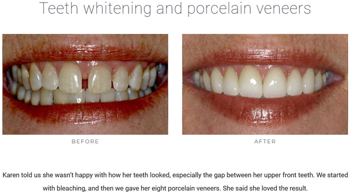 Before and after teeth gap pictures, which wisdom teeth eruption may not close, but porcelain veneers can