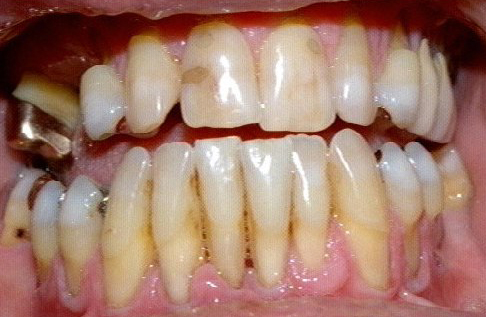 Close-up picture of teeth with most of the roots exposed. Teeth will fall out without treatment.