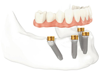 Diagram of an implant-supported denture hovering above four dental implants in the lower jaw