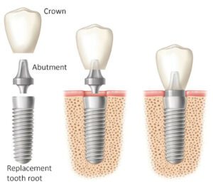 A dental implant with crown, abutment, and replacement tooth root labeled, followed by the implant screw in the bone, and finally all implant parts connected