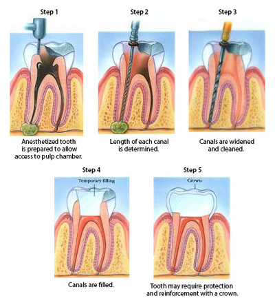 Five-step diagram of root canal treatment: accessing tooth, from removing the infection to filling and sealing the tooth