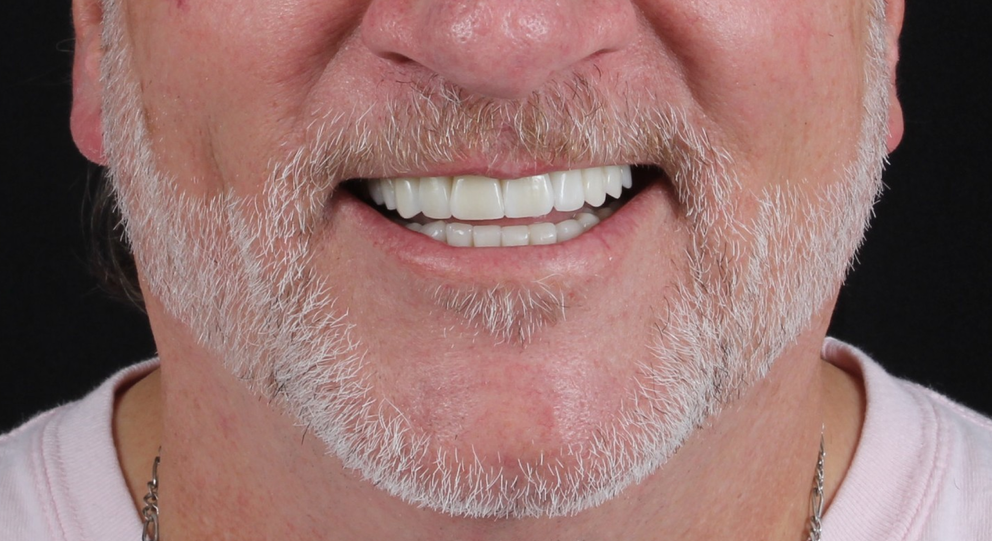 Full Mouth Reconstruction