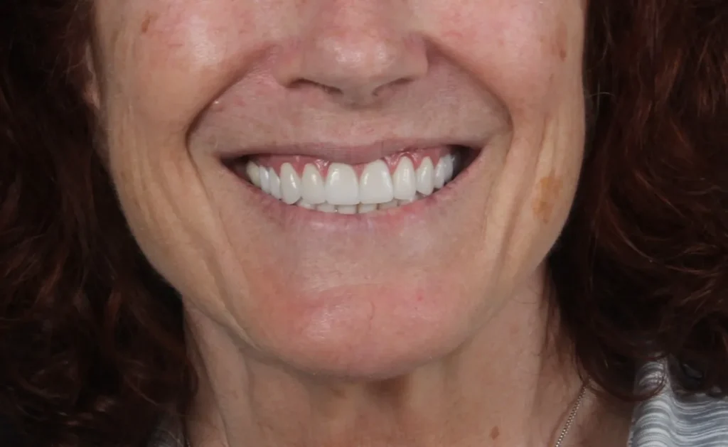 A patient of Dr. Tostado's before her smile makeover