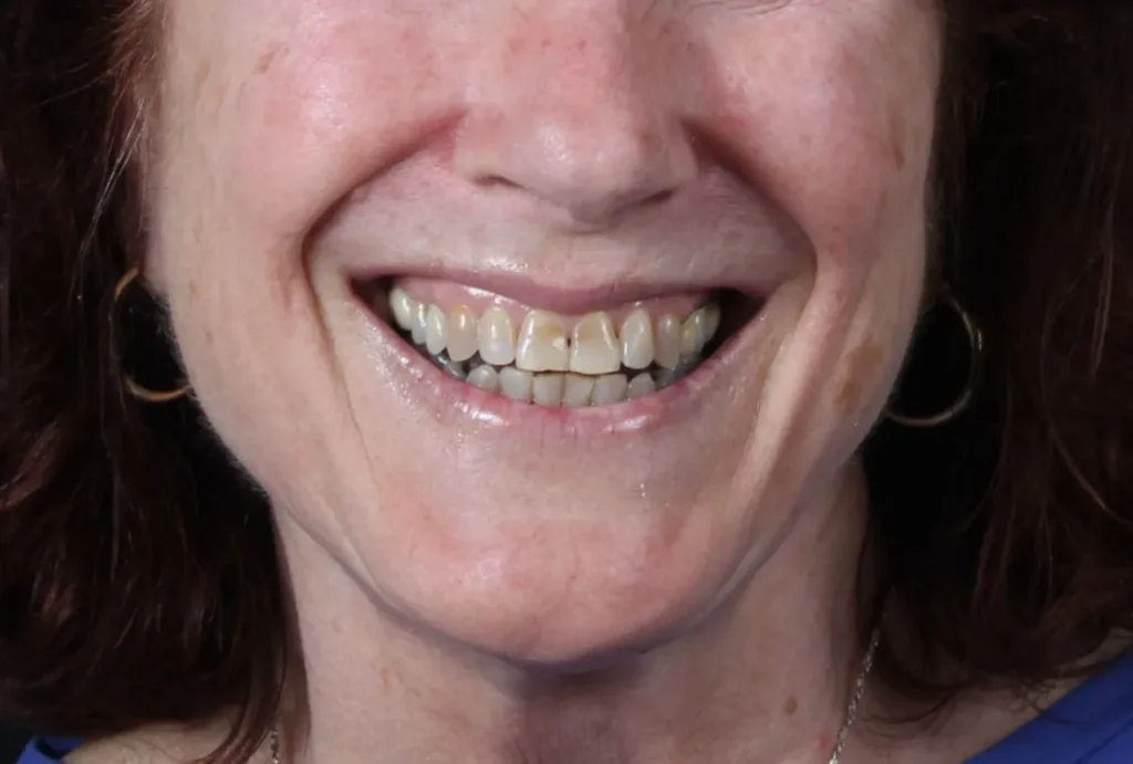 A patient of Dr. Tostado's before her smile makeover